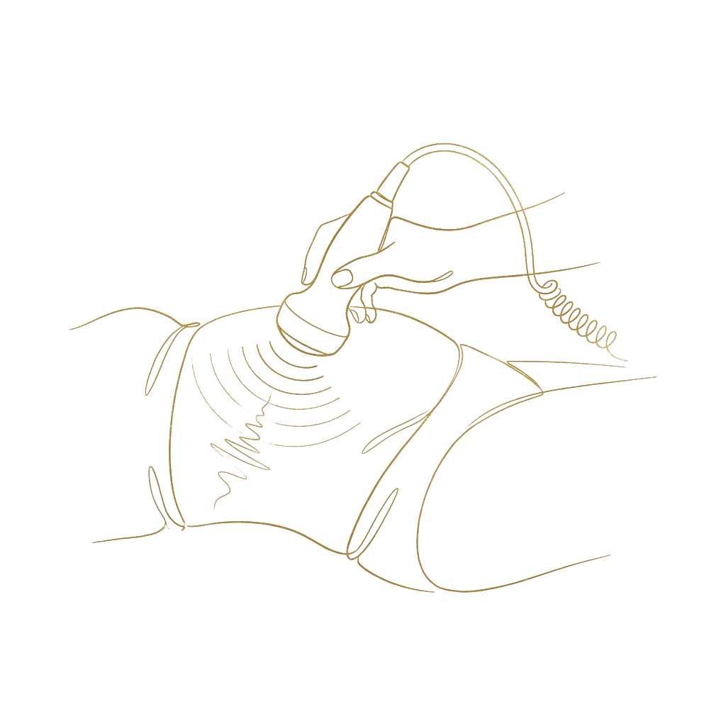 Ilustração do procedimento Heccus na Clínica Yodara